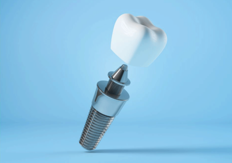 Ensuring the longevity of Dental Implants by Advanced Brookline Dental in Brookline, MA.