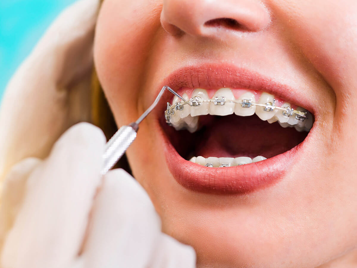 Metal Braces